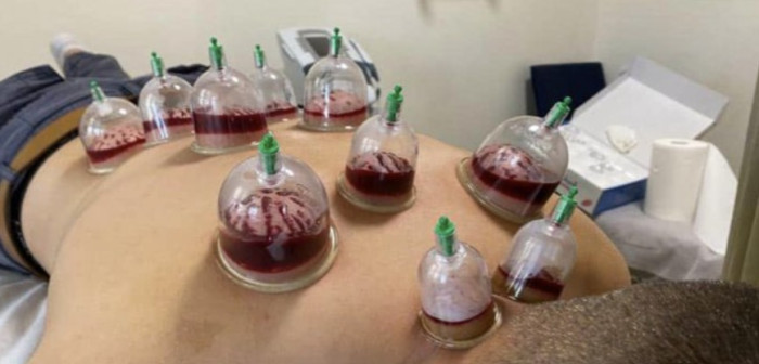 حجامت در طب سنتی؛ کاربردها، نکات مهم و موارد احتیاط