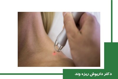 درمان زگیل تناسلی