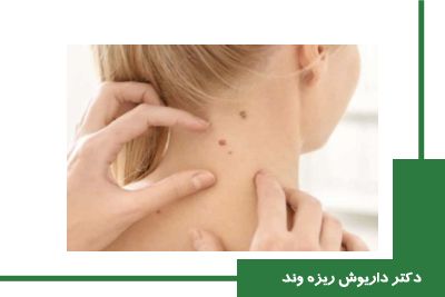 درمان زگیل سرطانی