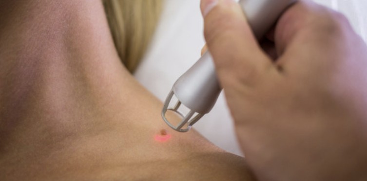 درمان زگیل تناسلی