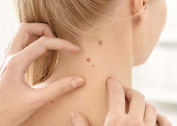 درمان زگیل سرطانی